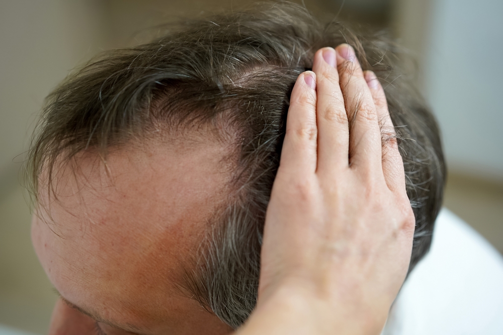 How Much Does a Hair Transplant Cost in Reston, VA?