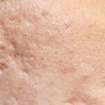 What Is the Best Acne Scar Treatment in Reston