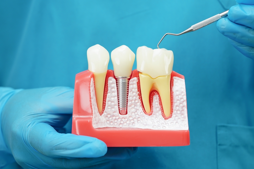 How Much Do Dental Implants Cost in Vienna, VA? A Local Pricing Guide